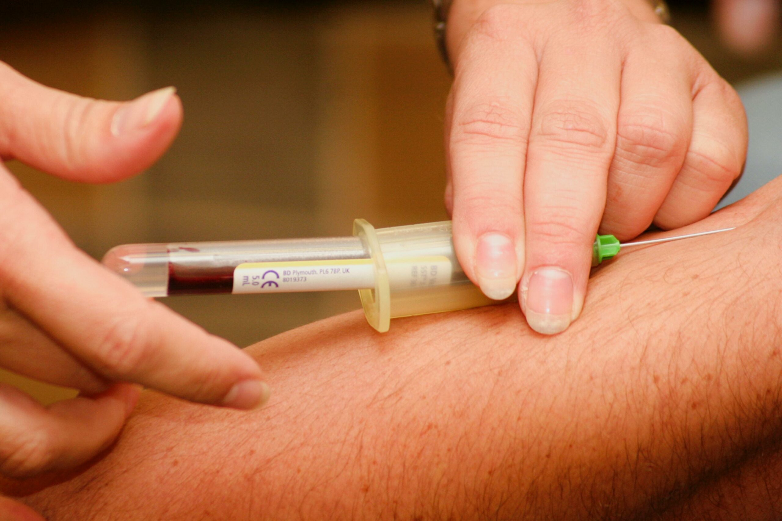 Fascinating facts about acupuncture