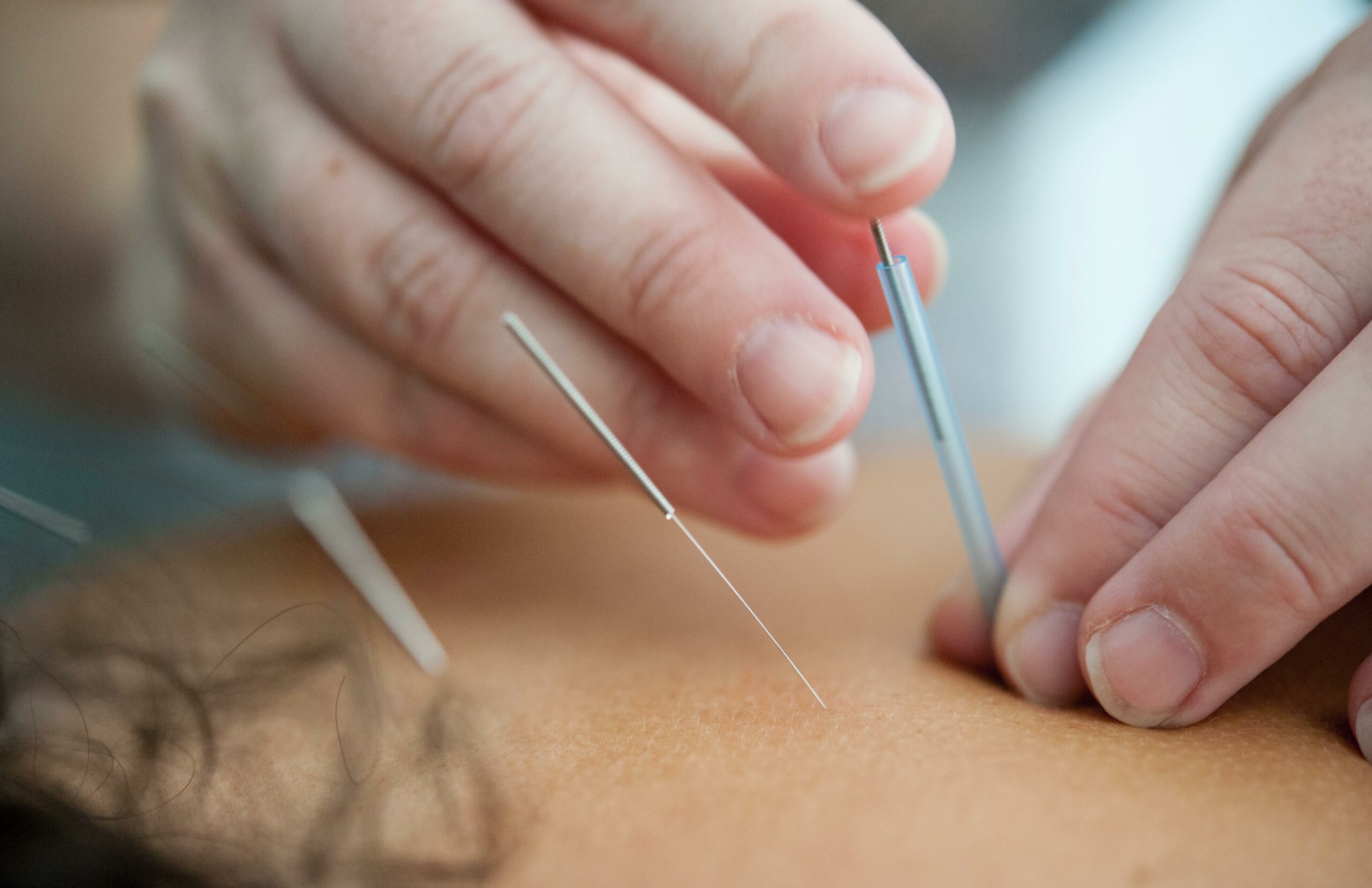 When Was Acupuncture Invented