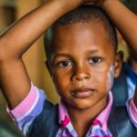 facts-about-hypertrophic-scars_featured