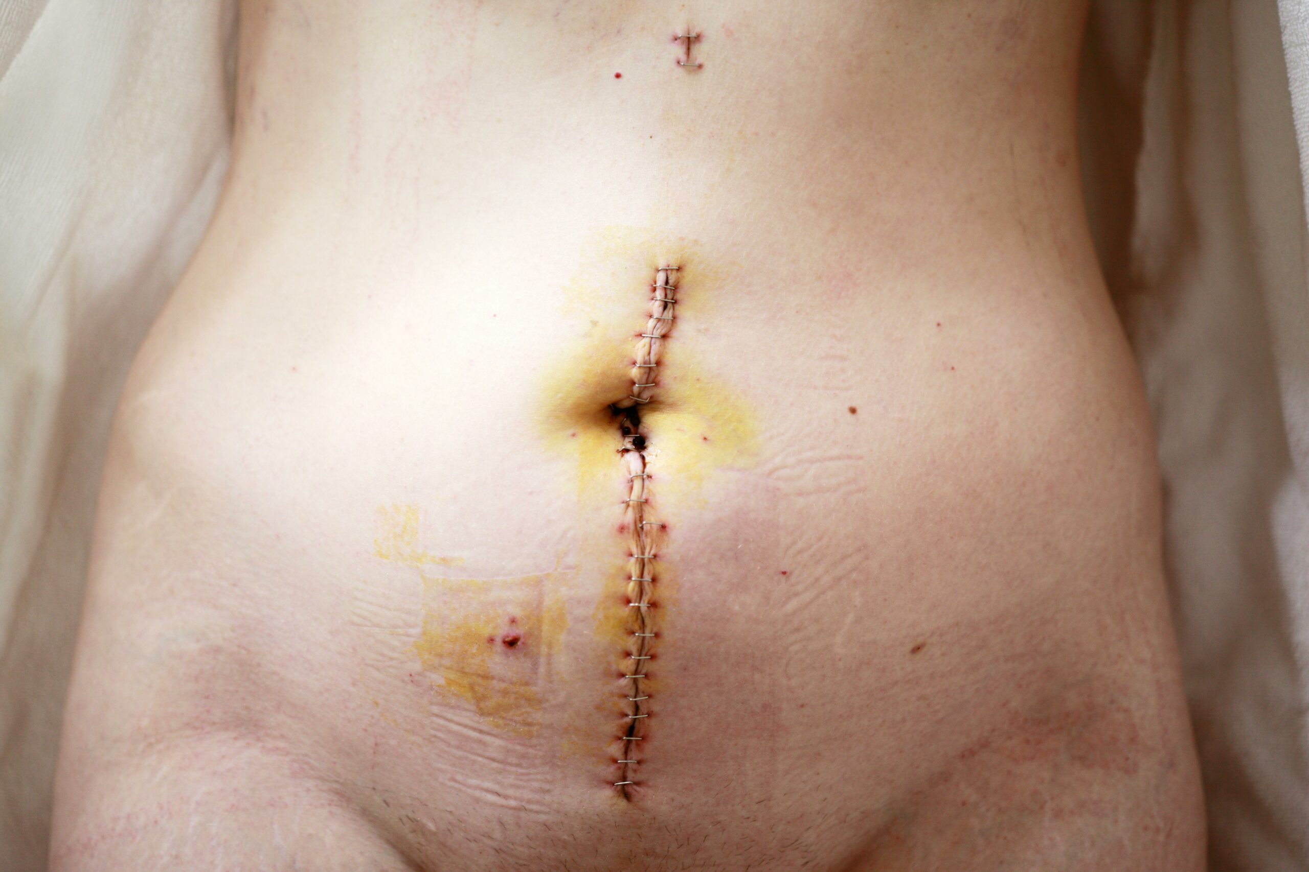 scar classification types