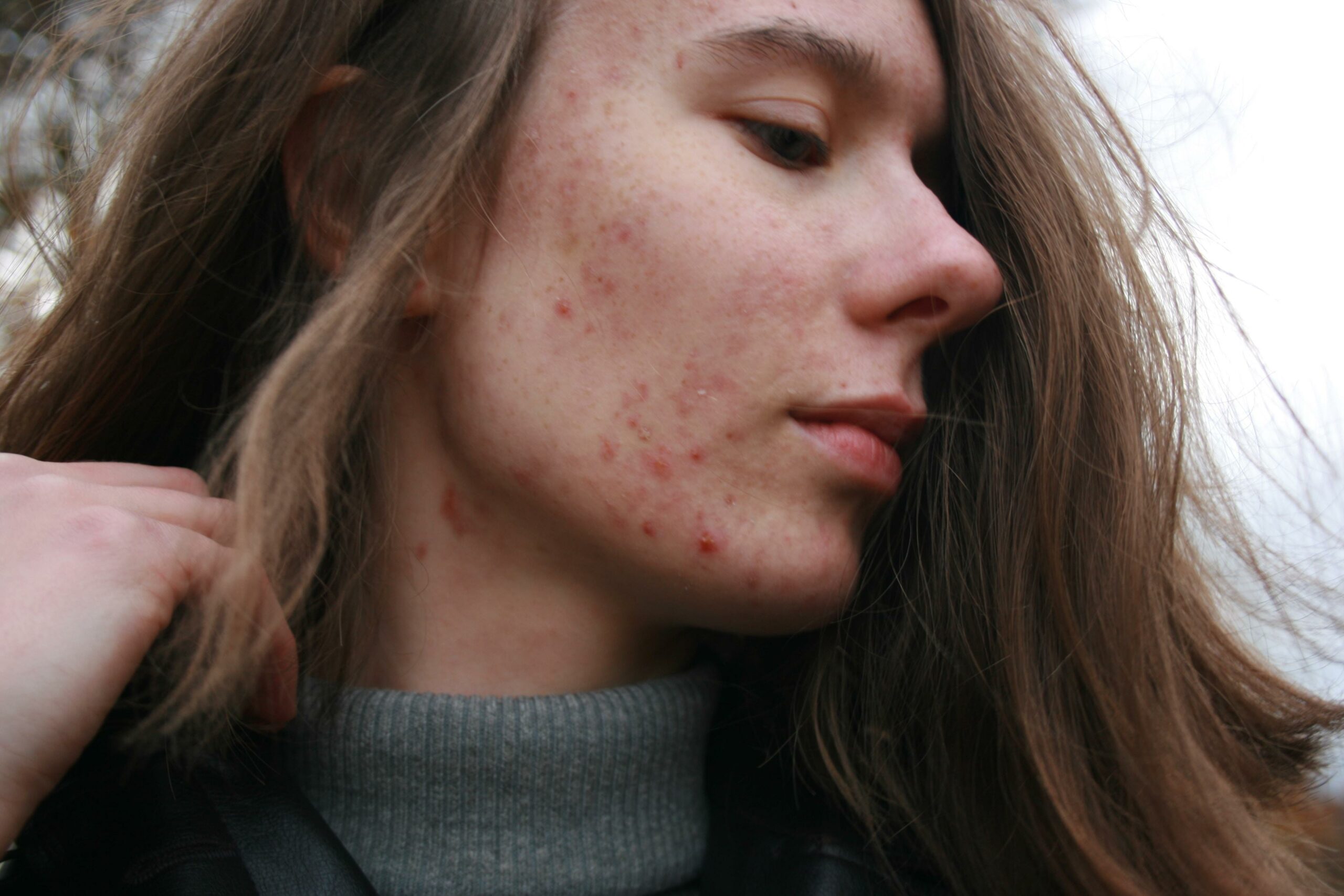 treatments for acne scars