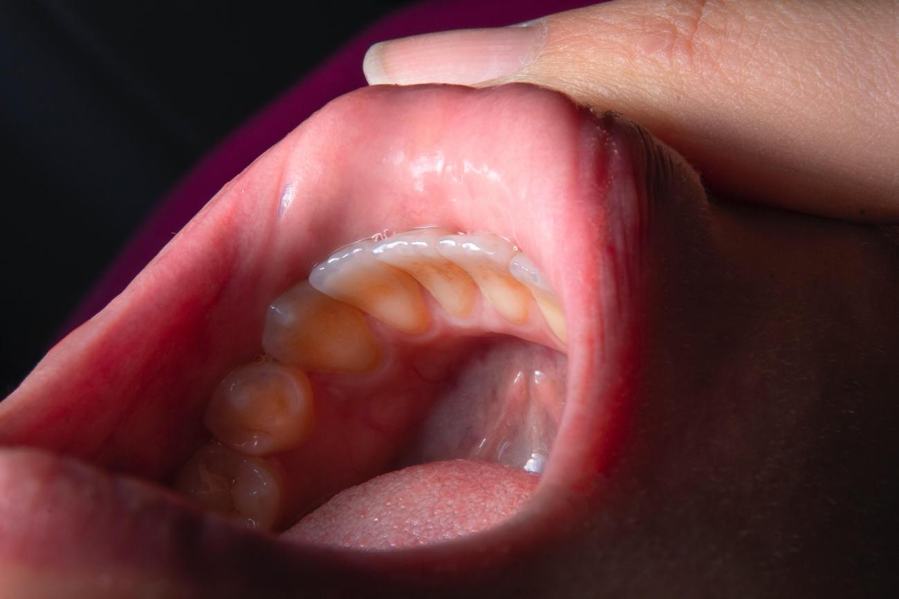 Various types of teeth alignment devices