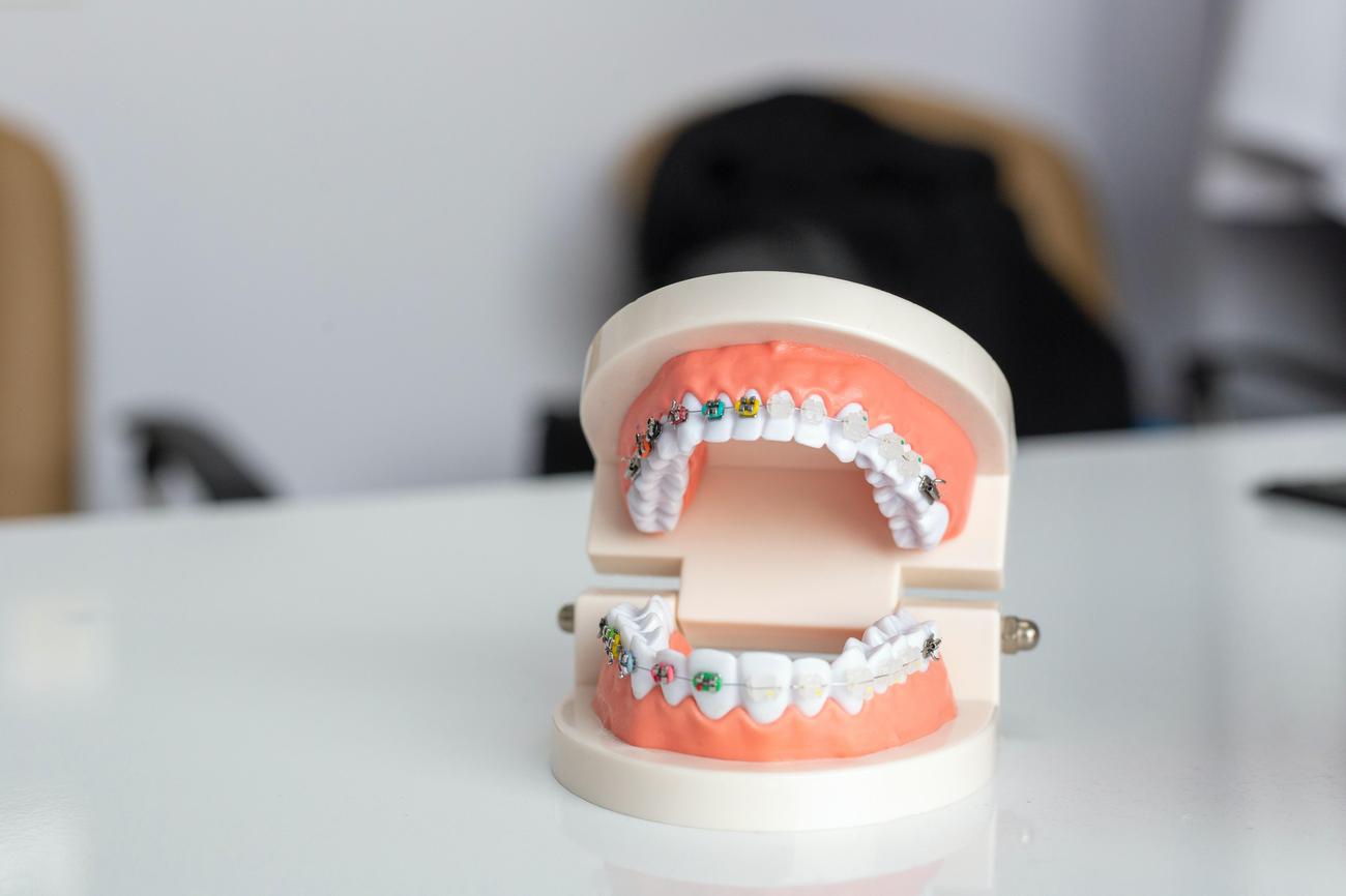 facts about braces