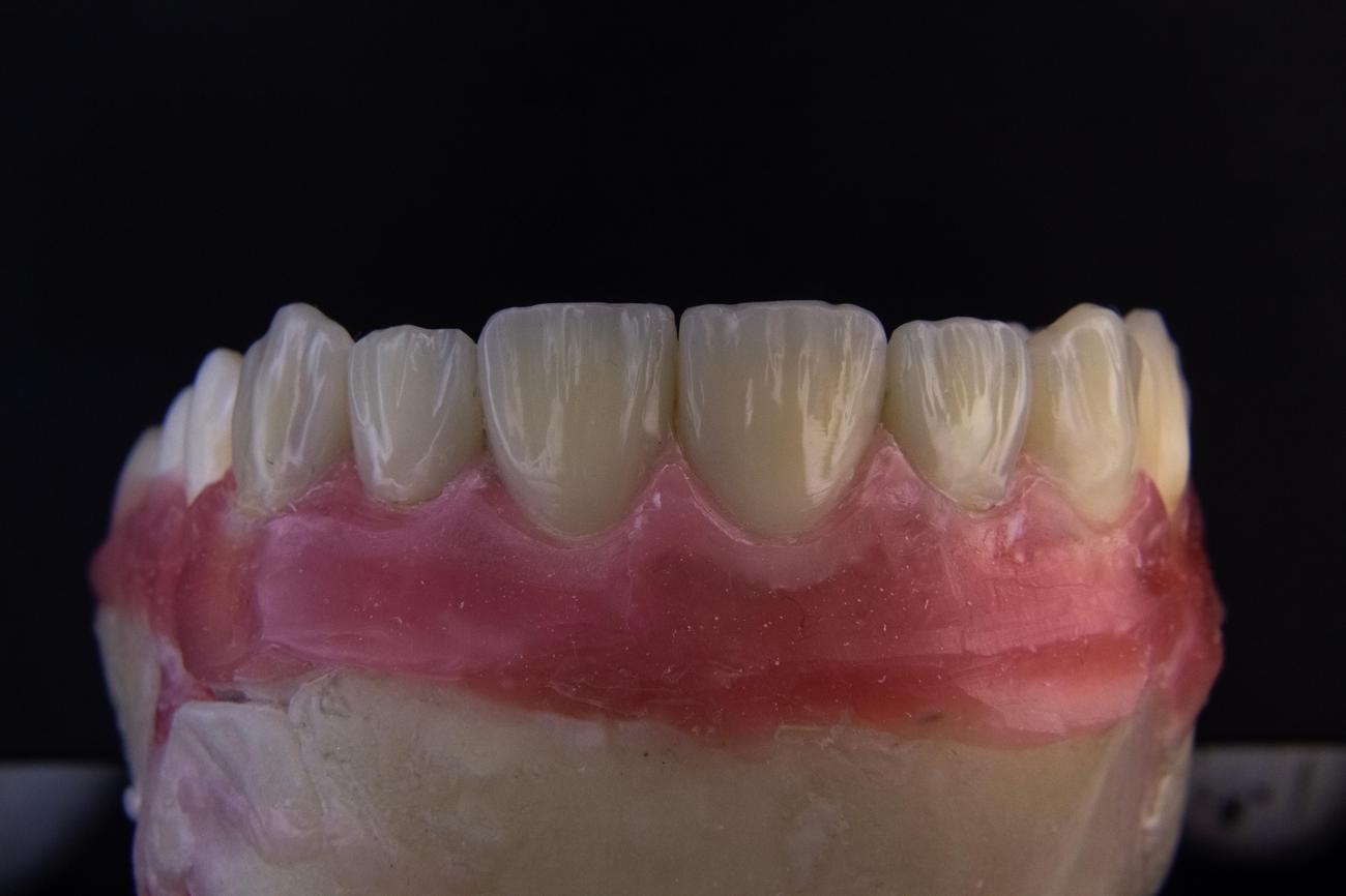 facts about braces
