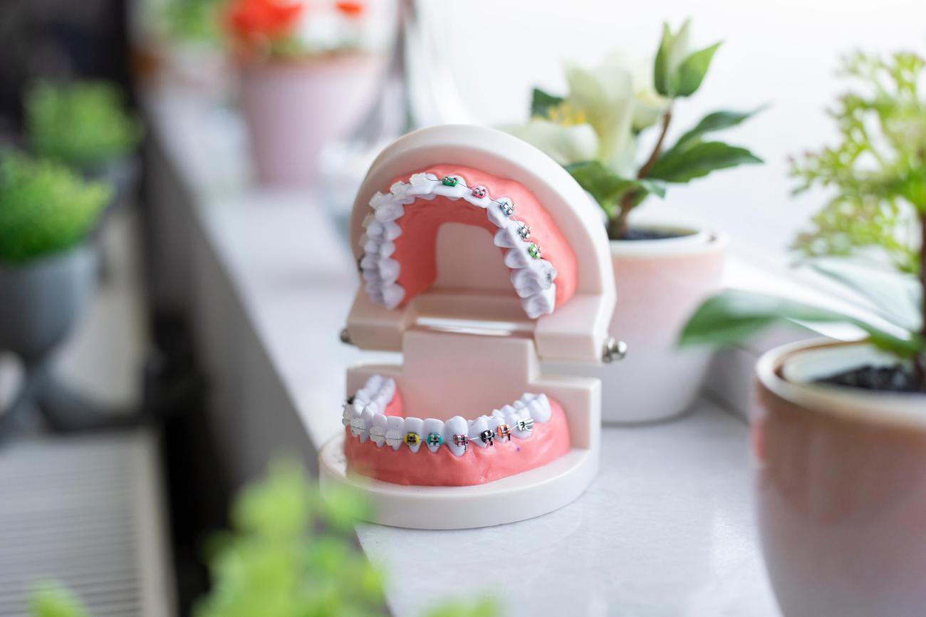 how long does it take to put on braces