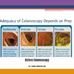Cleaning-out-colon-before-colonoscopy_2