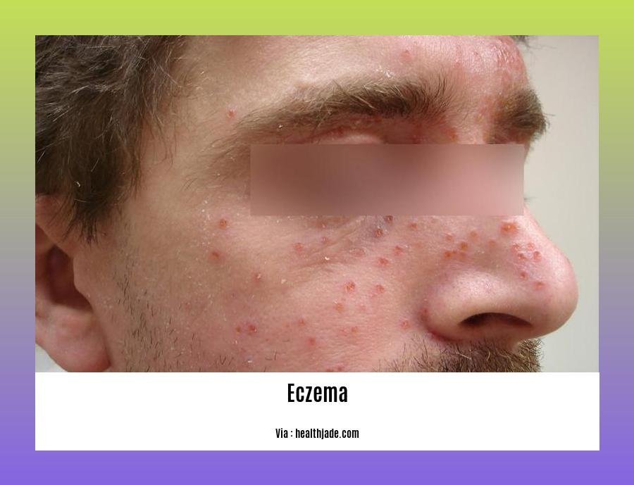 Detox diet for eczema