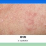 Detox-diet-for-eczema_2