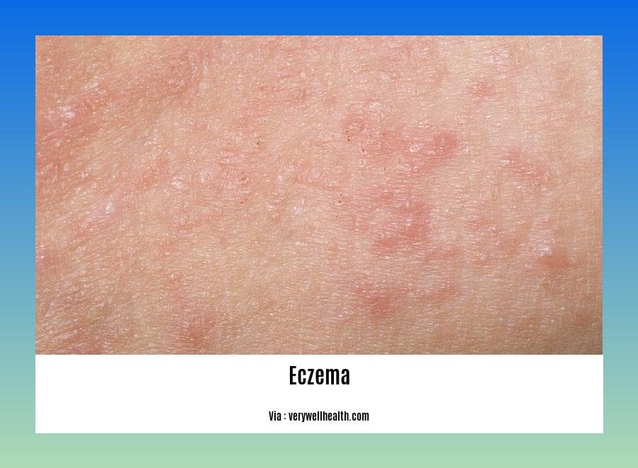 Detox diet for eczema 2