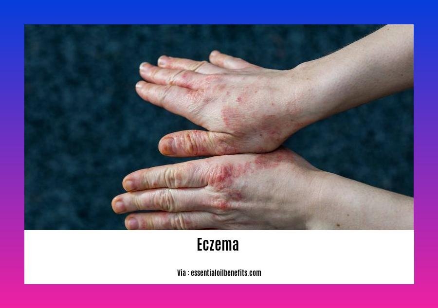 Detox eczema flare up