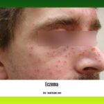 Detox-eczema-flare-up_2