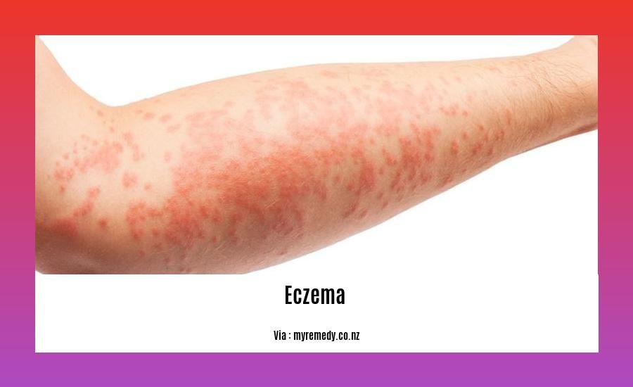 Detox eczema flare up