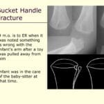bucket_handle_fracture