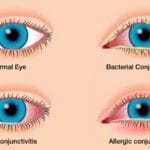 how_long_does_pink_eye_bacteria_stay_on_surfaces