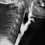 cricopharyngeal_bar