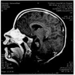 dipg_survival_rate