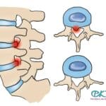 hernia_nucleus_pulposus_icd_10