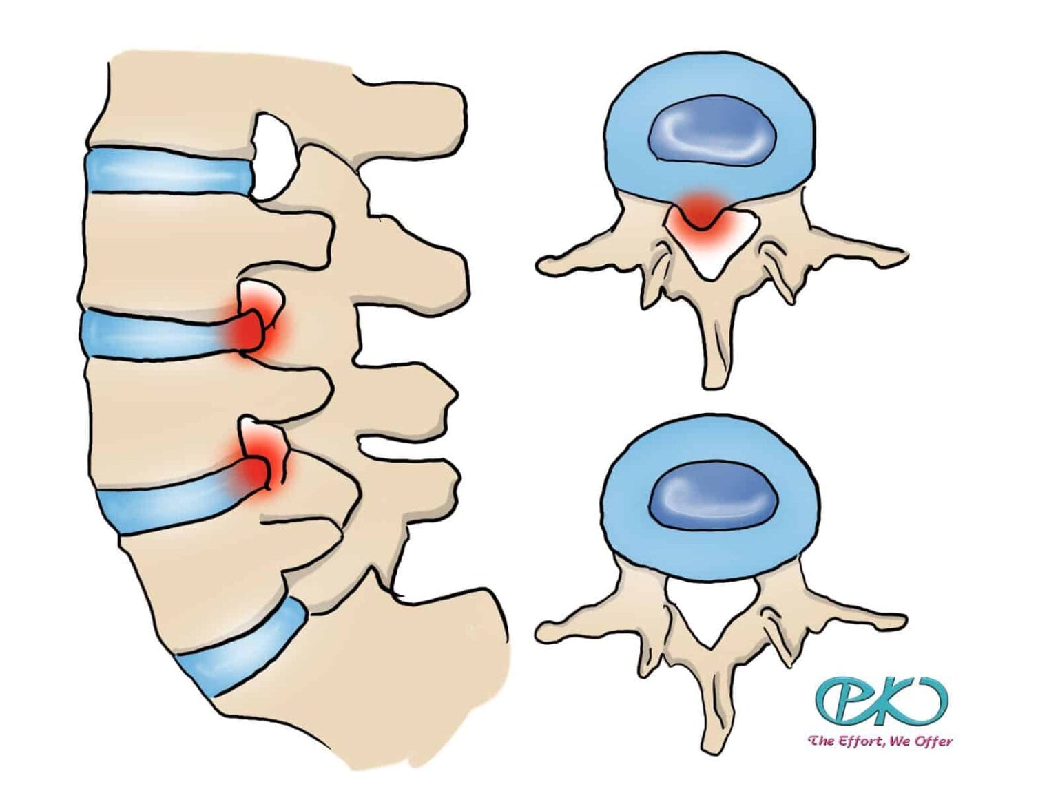 icd 10 code for left l4 l5 herniated nucleus pulposus