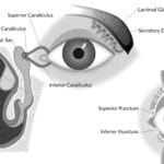 nasopharyngeal_stent