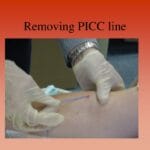 removal_of_a_picc_line