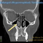swollen_turbinates_pictures