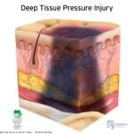 unstageable_pressure_injury