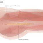 anterolateral_hip_precautions