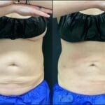 can_laser_lipo_damage_organs