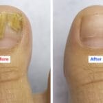 castor_oil_for_toenail_fungus