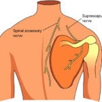 dorsal_scapular_nerve_entrapment
