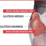dorsogluteal_site