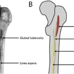 linea_aspera_femur