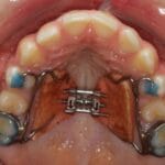 palate_expander_adults