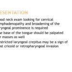 pharyngectomy