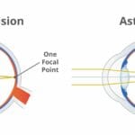 what_causes_astigmatism_to_worsen